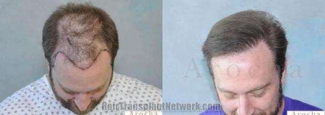 Hair restoration procedure before and after results