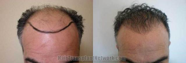 Hair restoration procedure before and after results