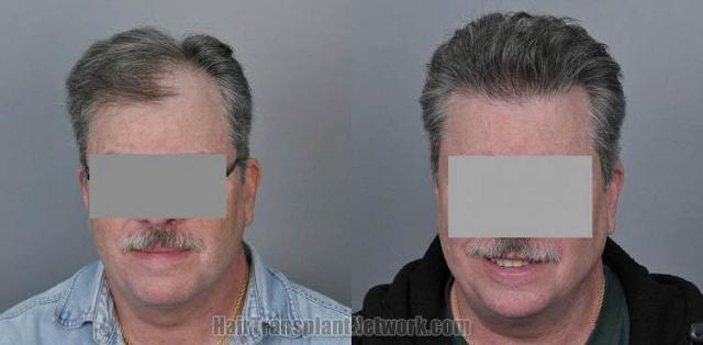 Hair restoration procedure before and after results