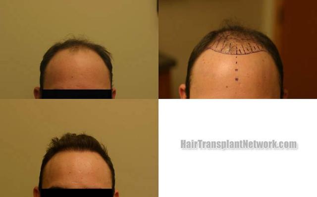 Hair transplantation surgery before and after photos