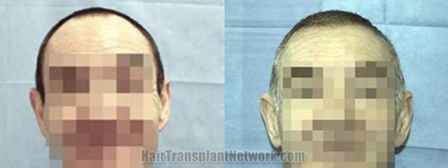 Hair restoration procedure before and after results