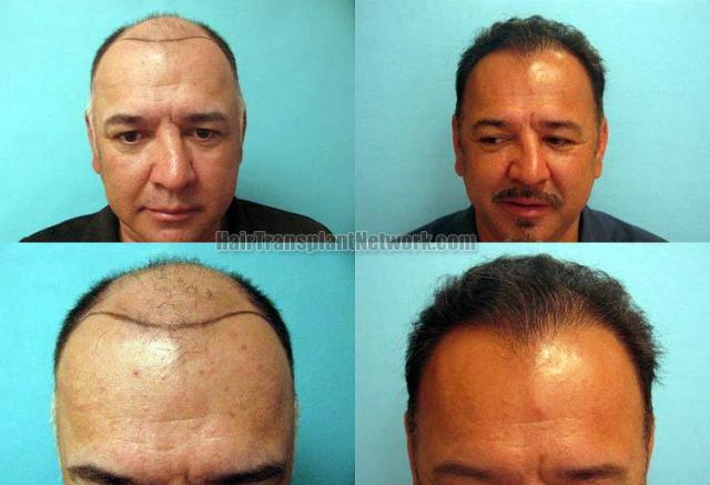 Hair restoration procedure before and after results