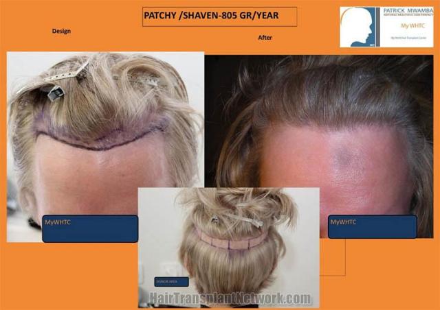 Before and after hair transplantation result photographs