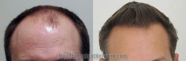 Hair transplantation surgery before and after photos