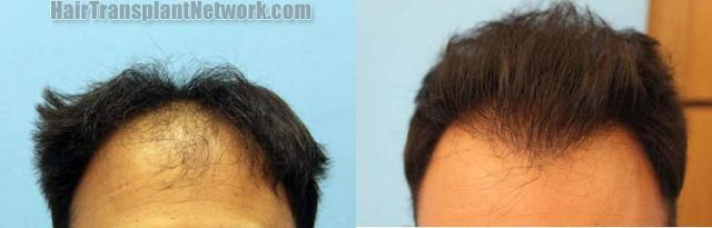 Before and after hair transplantation result photographs