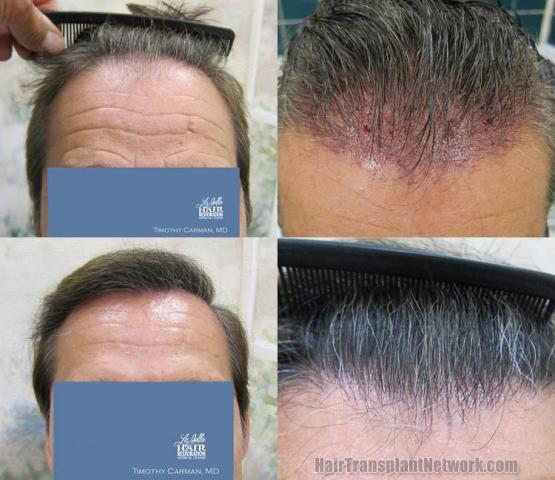 Hair transplantation surgery before and after images