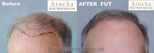 Hair transplantation surgery before and after photos