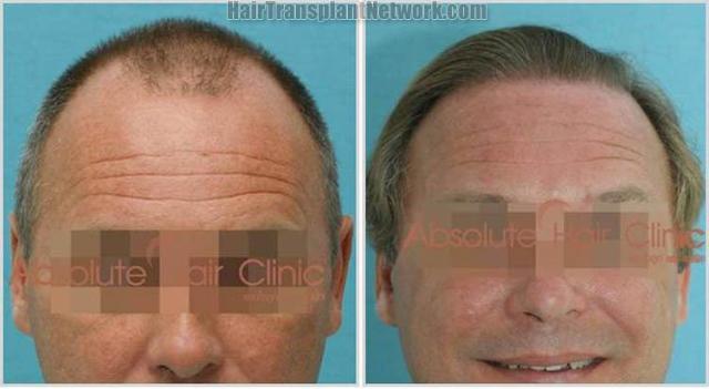 Before and after hair transplantation surgery