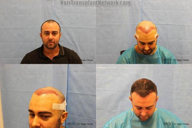 Hair transplantation surgery before and after pictures