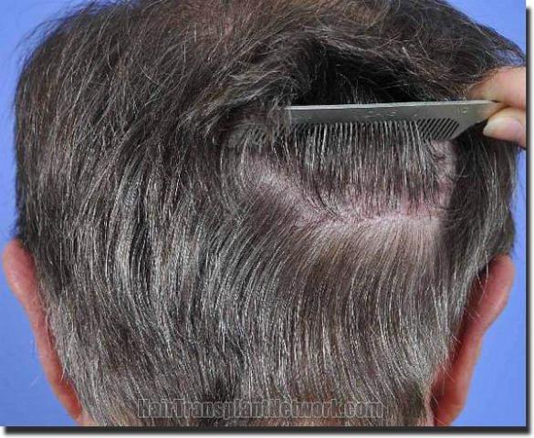 Hair restoration procedure results