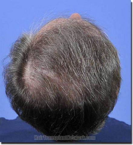 Hair restoration procedure results