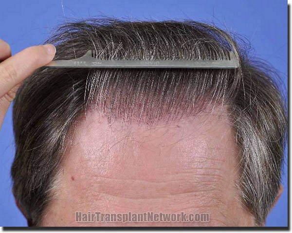 Hair restoration procedure results