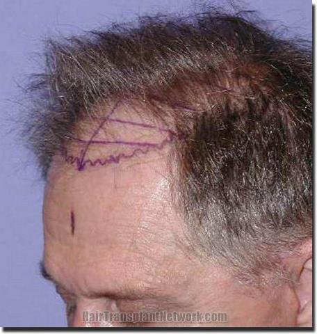 Hair restoration procedure results