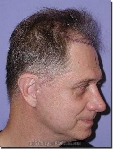 Hair restoration procedure results