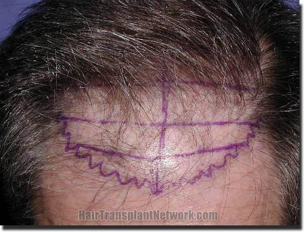 Hair restoration procedure results