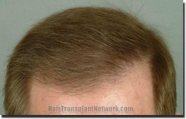 Hair restoration procedure results