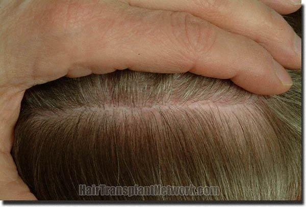 Hair restoration procedure results