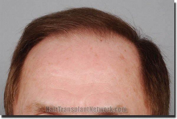 Hair restoration procedure results