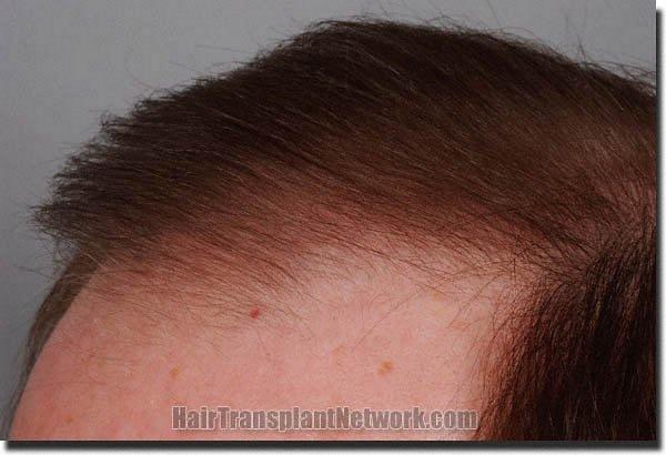 Hair restoration procedure results