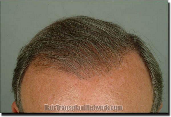 Hair restoration procedure results