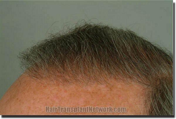 Hair restoration procedure results