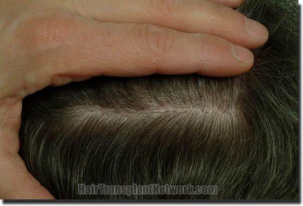 Hair restoration procedure results