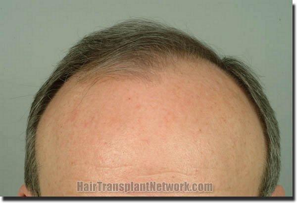 Hair restoration procedure results