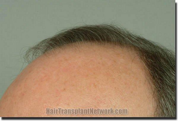 Hair restoration procedure results