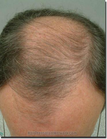 Hair restoration procedure results