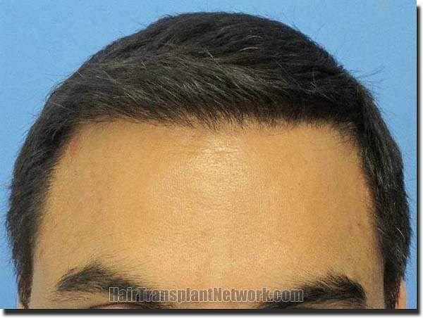 Hair restoration procedure results