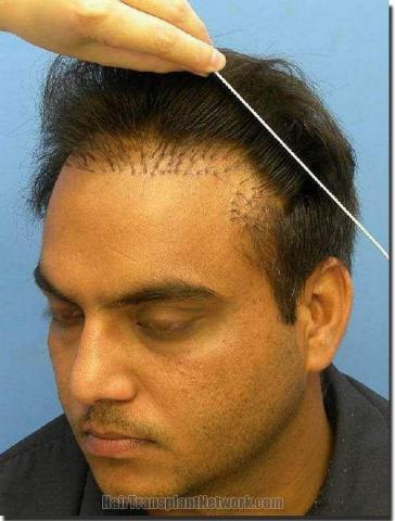 Hair restoration procedure results