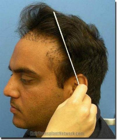 Hair restoration procedure results