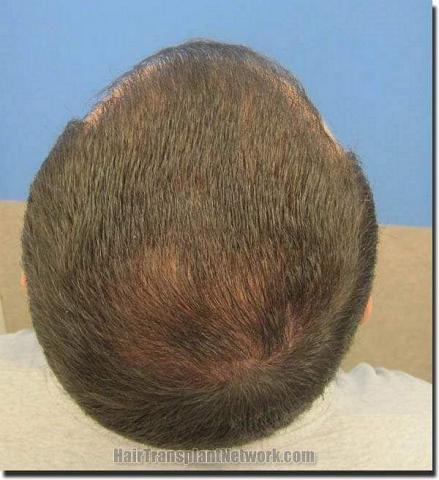 Hair restoration procedure results