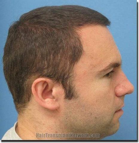 Hair restoration procedure results