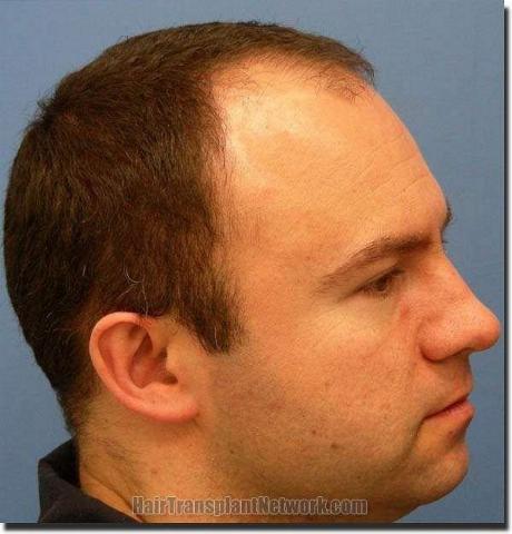 Hair restoration procedure results