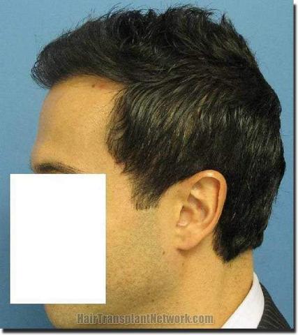 Hair restoration procedure results