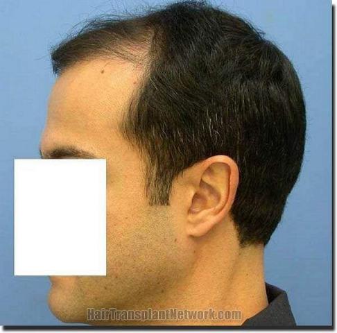 Hair restoration procedure results