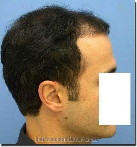 Hair restoration procedure results