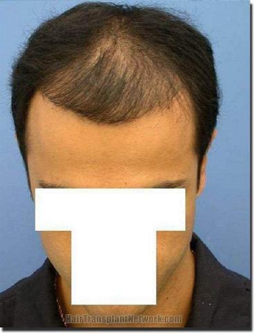 Hair restoration procedure results