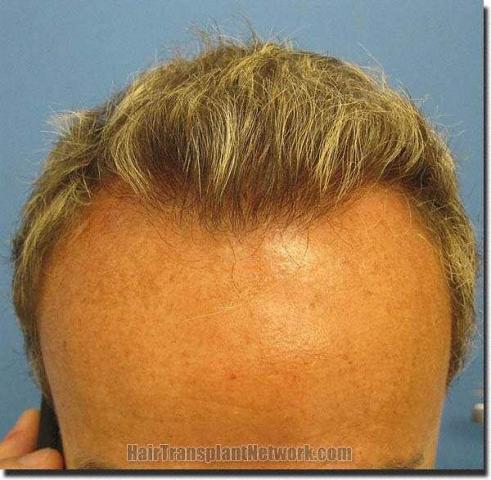 Hair restoration procedure results