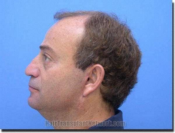 Hair restoration procedure results