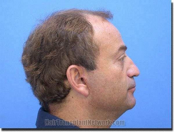 Hair restoration procedure results