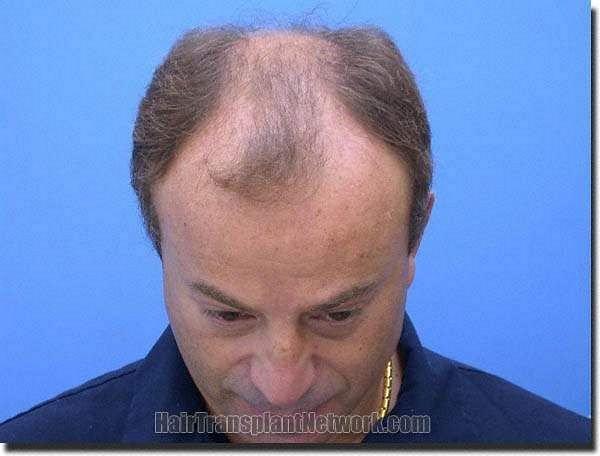 Hair restoration procedure results