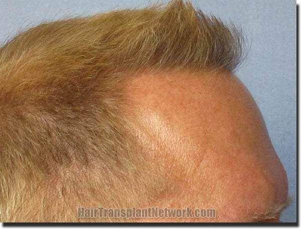 Hair restoration procedure results