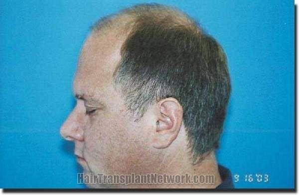 Hair restoration procedure results