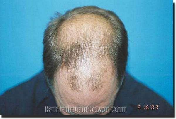 Hair restoration procedure results