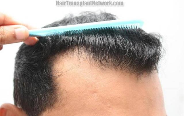 Hair restoration procedure before and after results