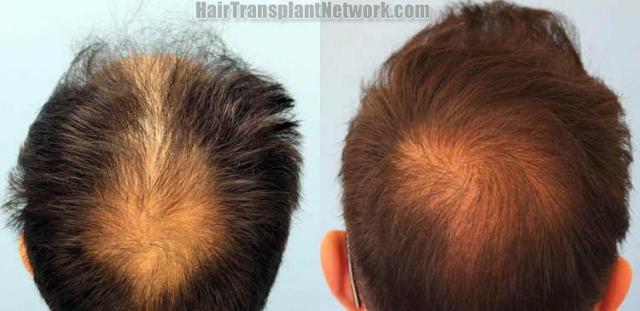 Hair transplantation surgery before and after photos