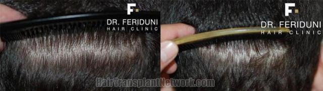 Back view before and after hair transplantation photos