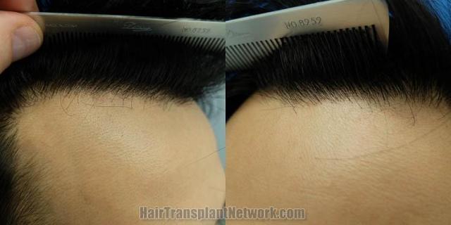 Hair restoration surgery closeup after photos